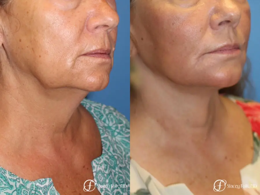 Denver Facial Rejuvenation Face Lift, Fat Injection, Laser Resurfacing 7123 - Before and After 2