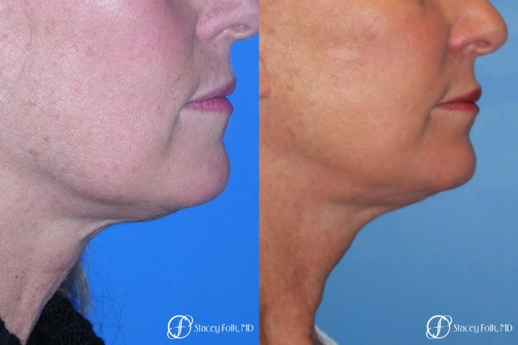 Denver Facial Rejuvenation 7916 - Before and After 2