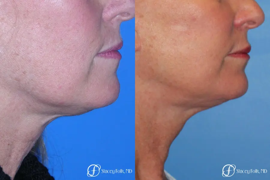 Denver Facial Rejuvenation 7916 - Before and After 2