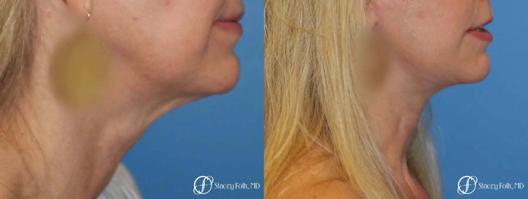 Denver Facial Rejuvenation Face Lift and Fat Injections 7126 - Before and After 1