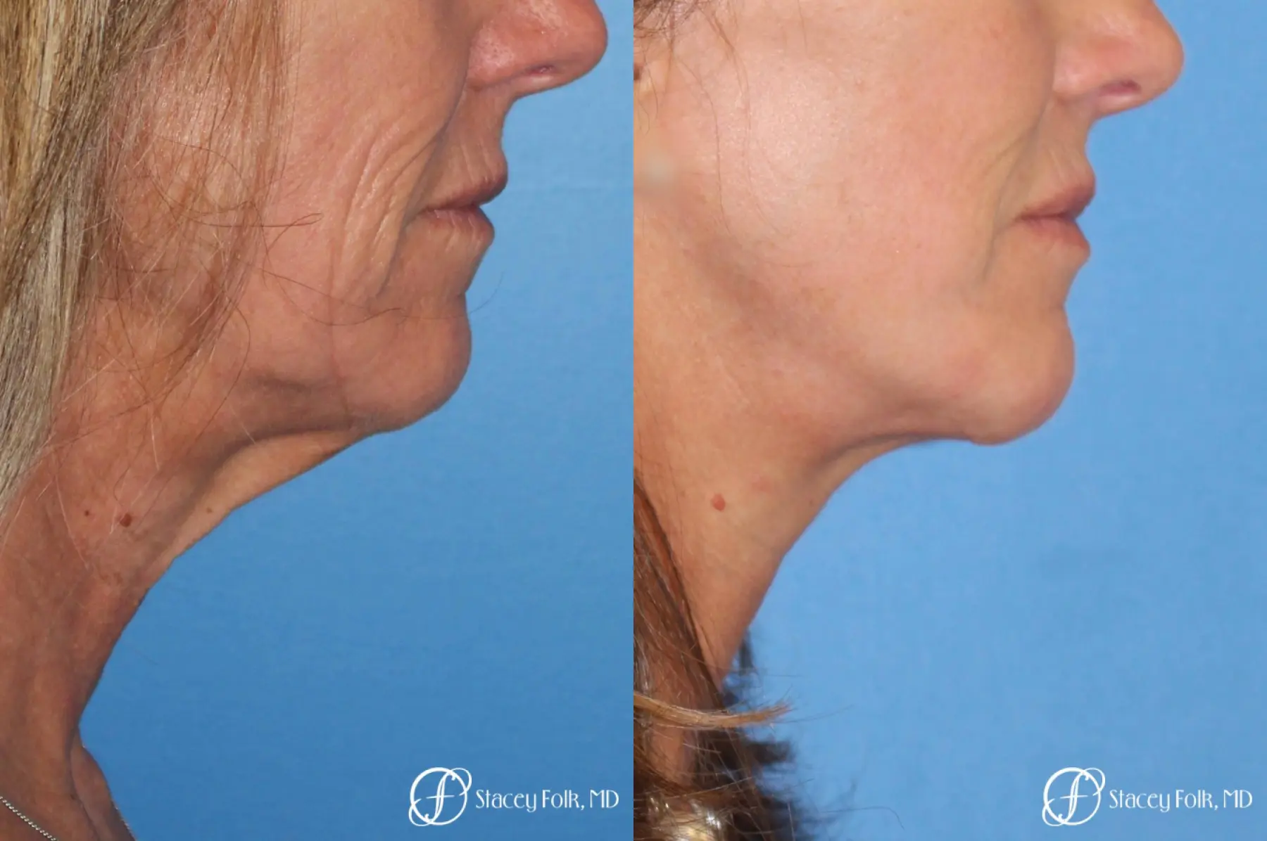 Denver Facial Rejuvenation Face lift, Fat Injections, and Laser Resurfacing 7132 - Before and After