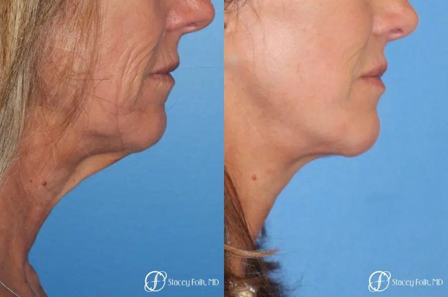 Denver Facial Rejuvenation Face lift, Fat Injections, and Laser Resurfacing 7132 - Before and After 1