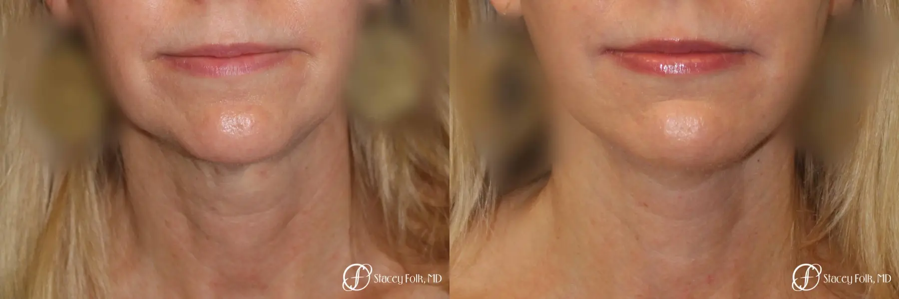 Denver Facial Rejuvenation Face Lift and Fat Injections 7126 - Before and After 3