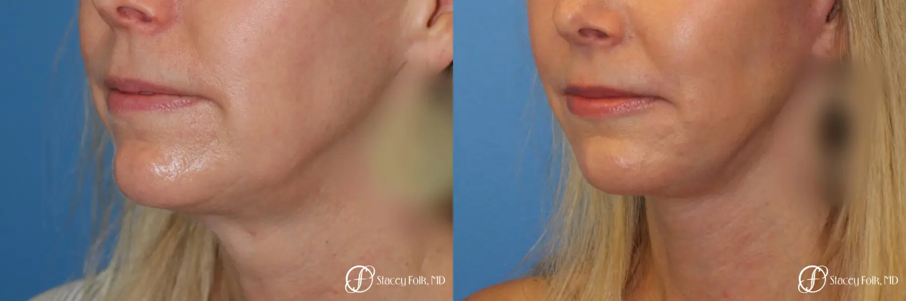 Denver Facial Rejuvenation Face Lift and Fat Injections 7126 - Before and After 2