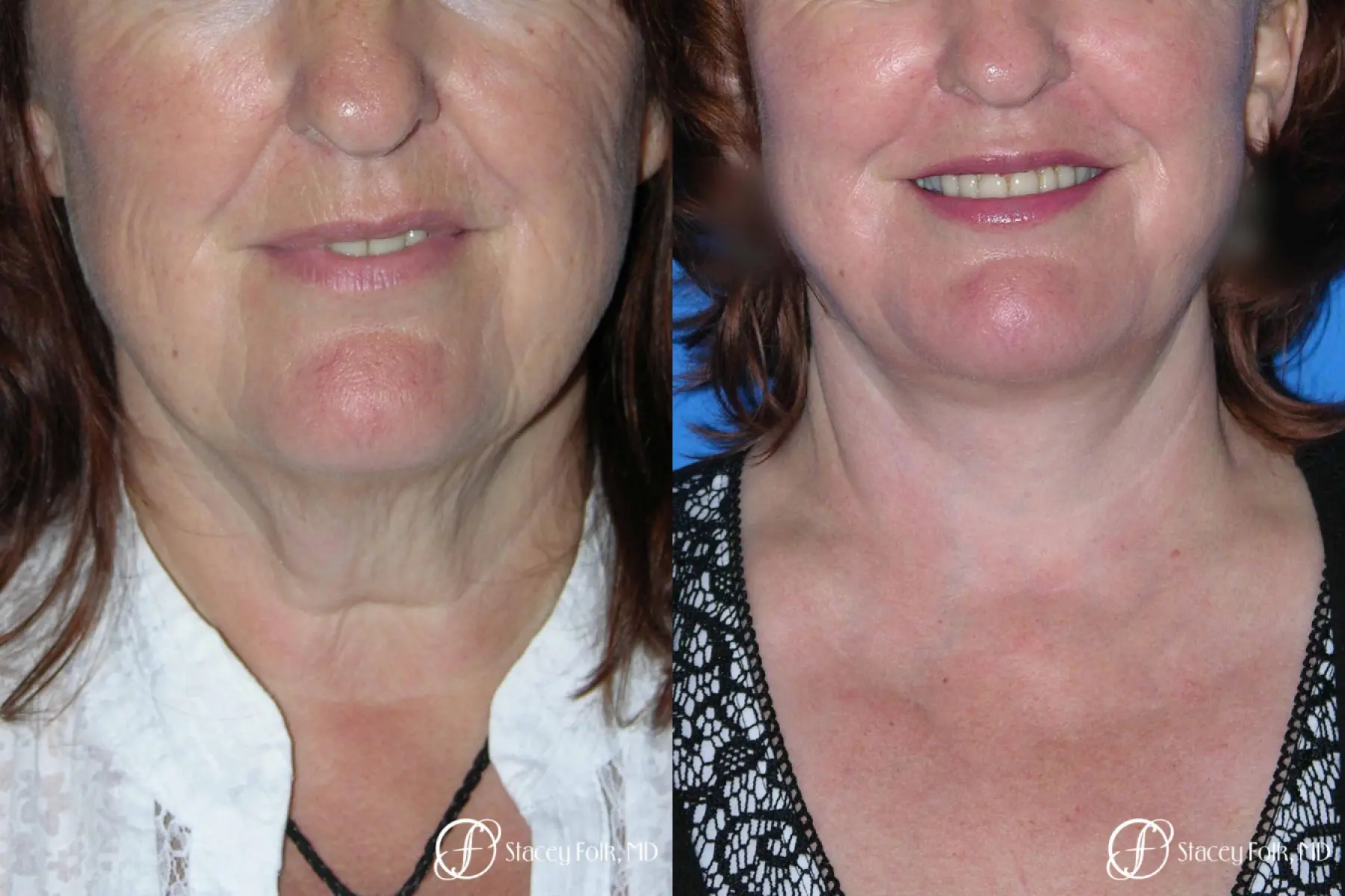 Denver Facial Rejuvenation Face lift, Fat Injections, Laser Resurfacing 7133 - Before and After 3