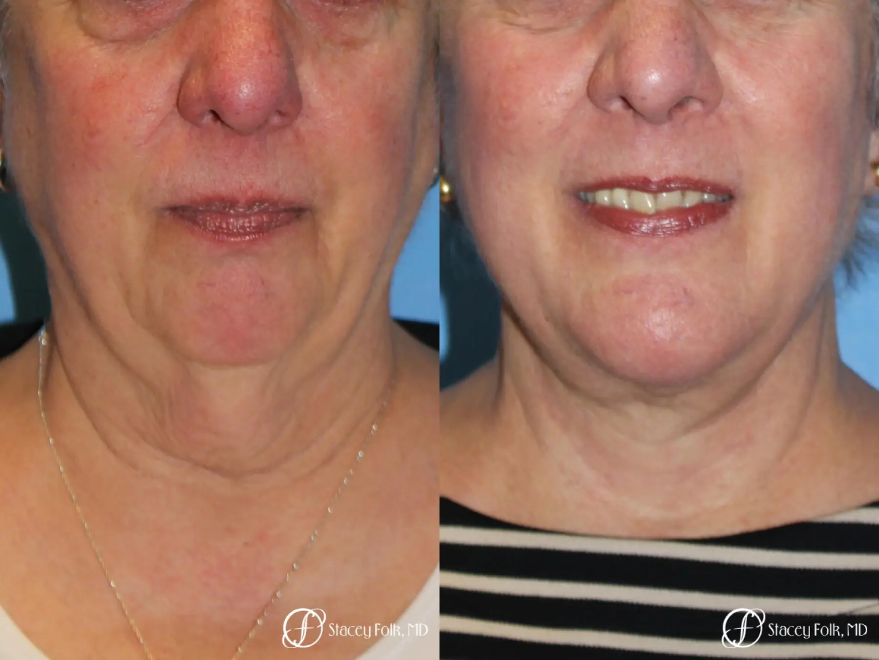 Denver Facial Rejuvenation Face and Neck Lift with Fat Transfer to the Face 9133 - Before and After 2