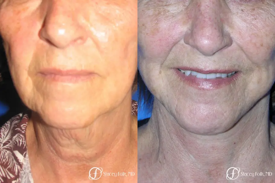 Denver Facial Rejuvenation Face Lift and Fat Injections 7129 - Before and After 3