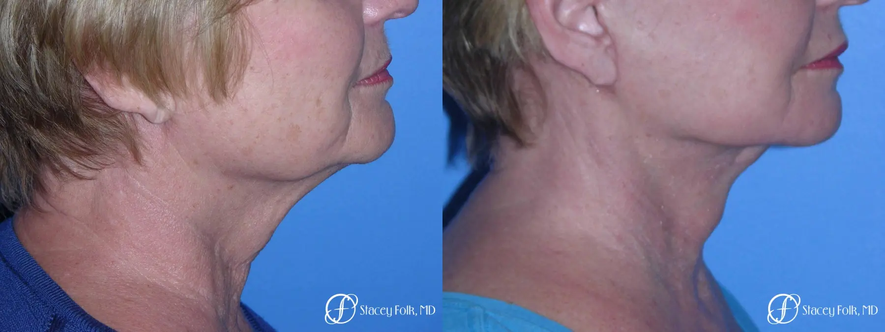 Denver Facial Rejuvenation Face Lift, Fat Injections, and Laser Resurfacing 7120 - Before and After 1