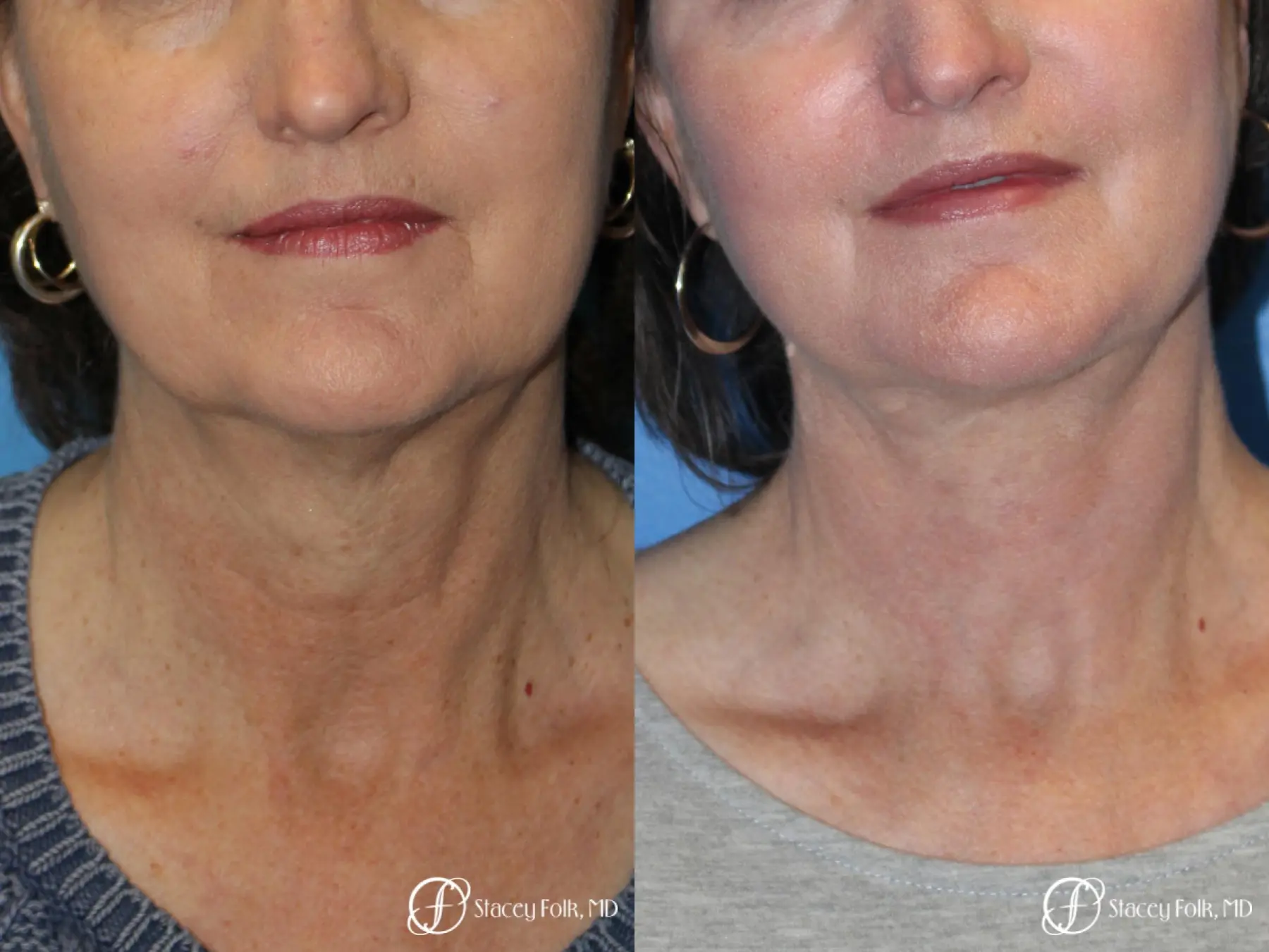 Denver Facial Rejuvenation Facelift, Blepharoplasty, Fat Transfer, Laser Resurfacing 10350 - Before and After 2