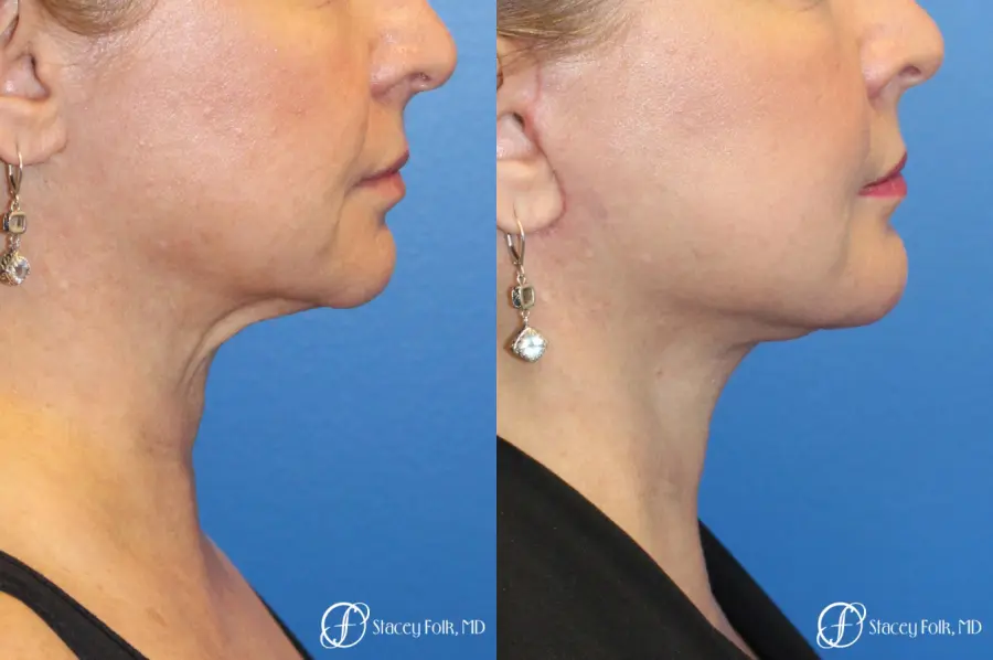 Denver Facial Rejuvenation 9894 - Before and After 1