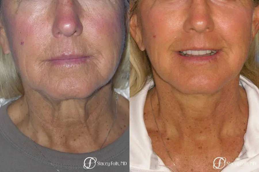Denver Facial Rejuvenation Face Lift and Laser Resurfacing 7119 - Before and After 3