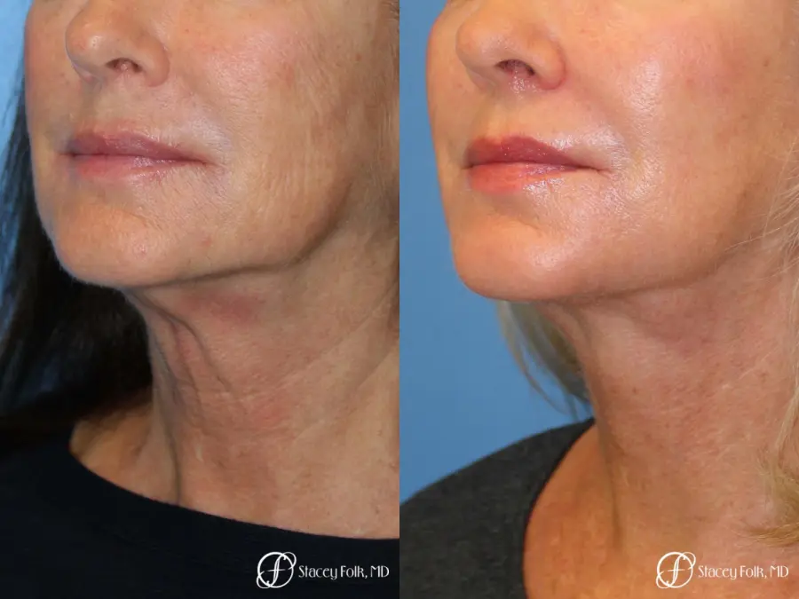 Denver Facelift & Laser Resurfacing 8277 - Before and After 2