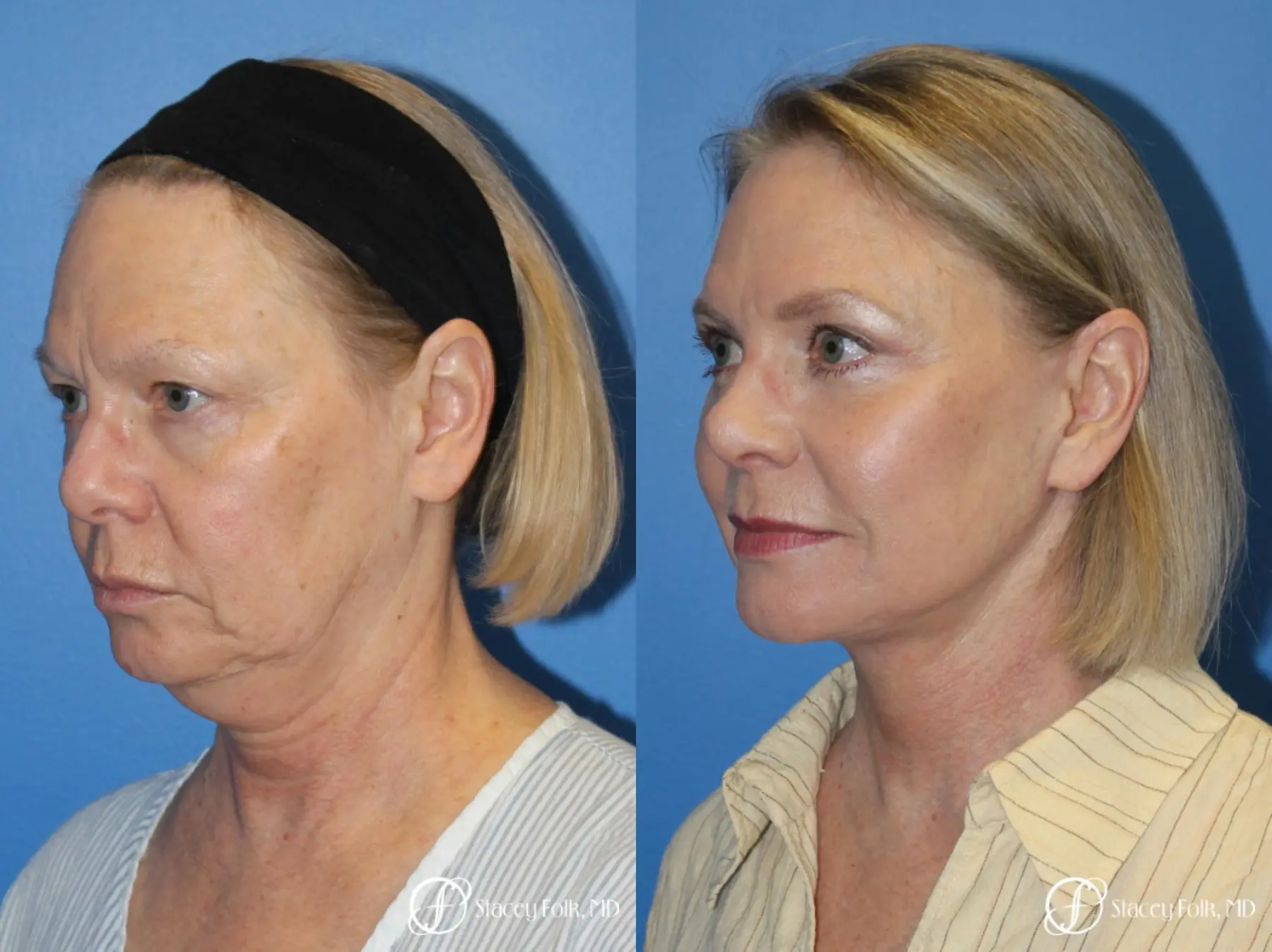 Facial Rejuvenation: Patient 1 - Before and After 2