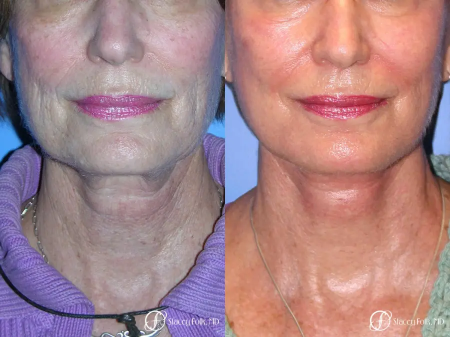 Denver Facial Rejuvenation Face Lift, Fat Injections, Laser Resurfacing 7116 - Before and After 3
