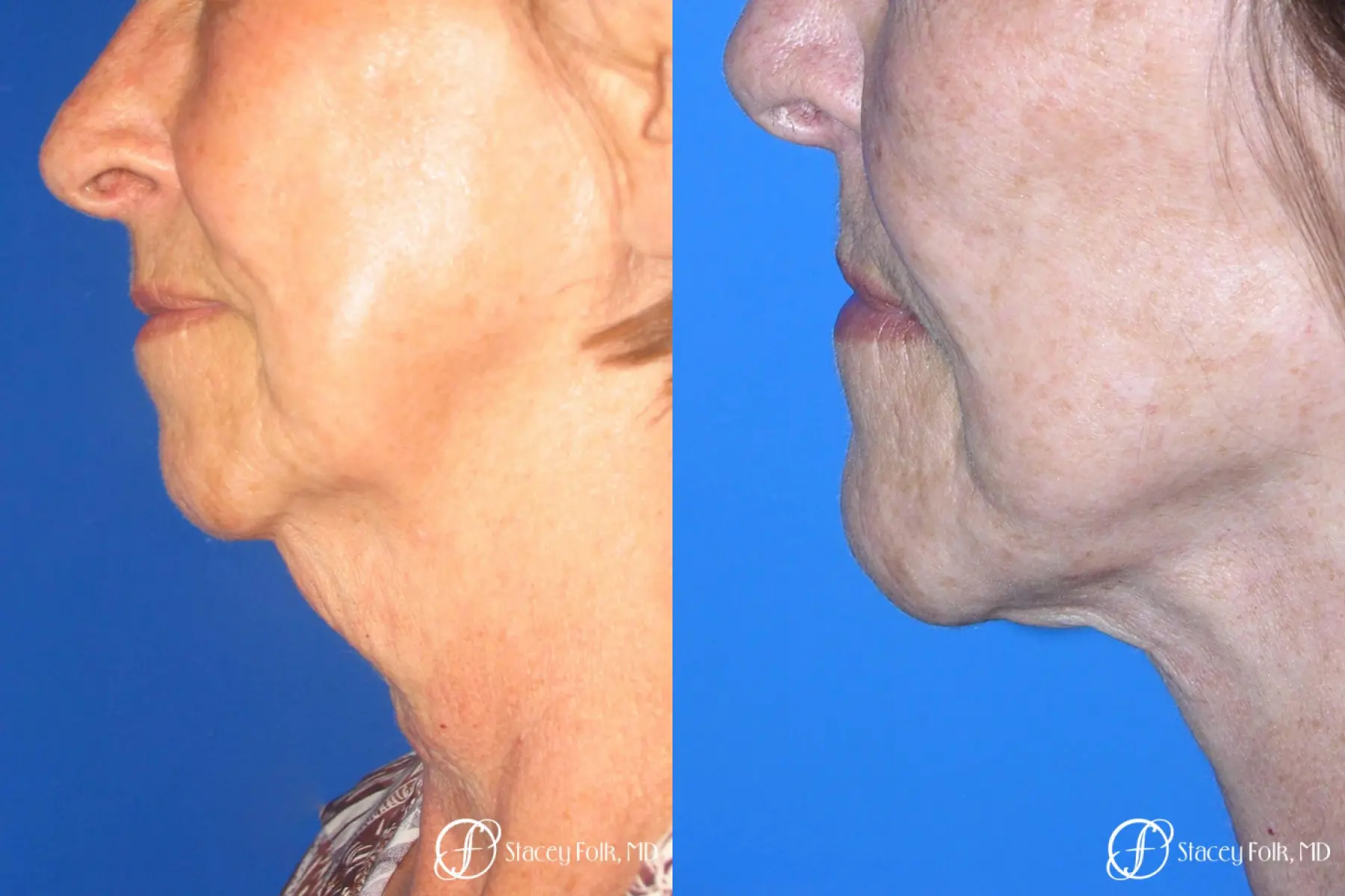 Denver Facial Rejuvenation Face Lift and Fat Injections 7129 - Before and After 1