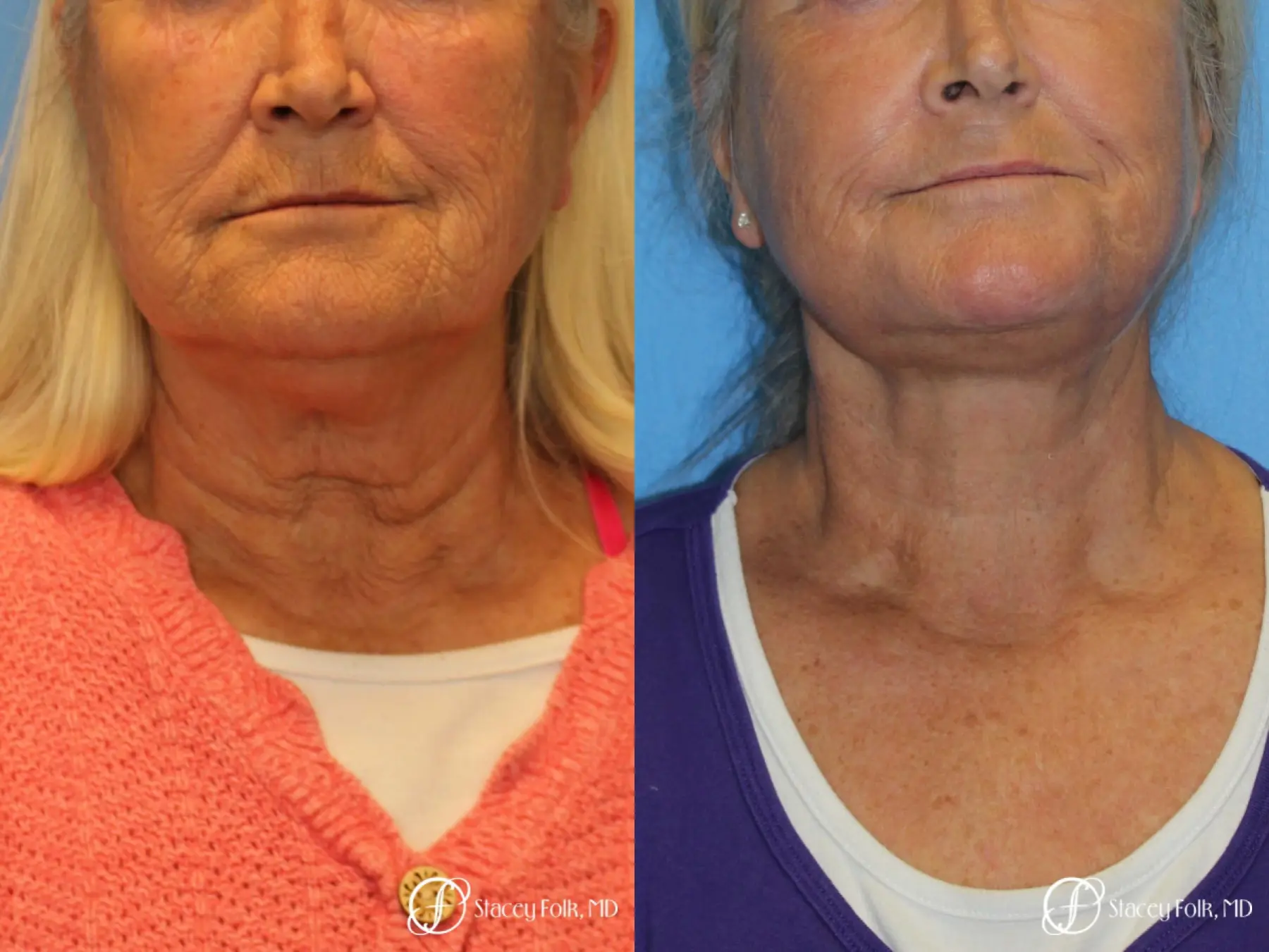 Facelift and Laser - Before and After 2