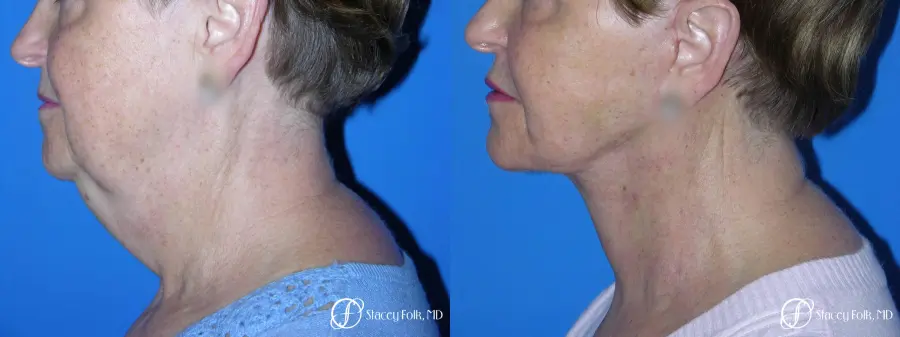 Denver Facial Rejuvenation Face Lift and Fat Injections 7130 - Before and After