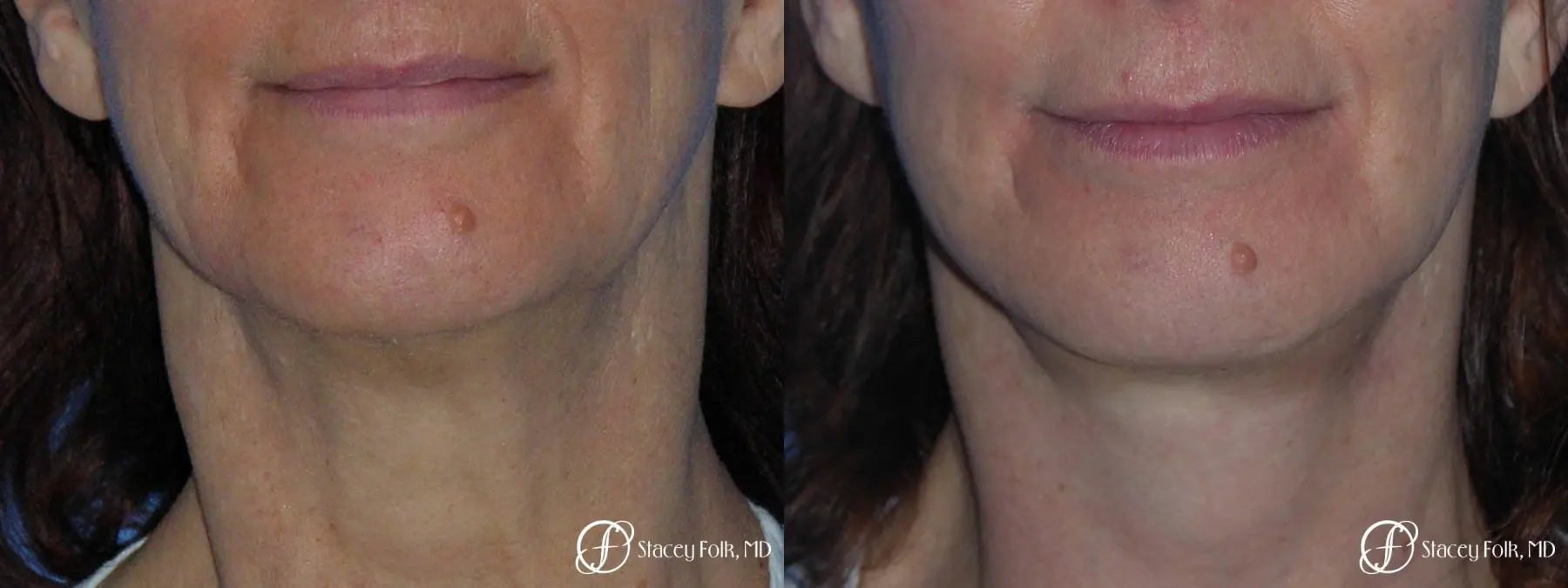 Denver Facial Rejuvenation Face Lift and Fat Injection 7124 - Before and After 1