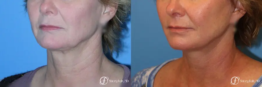 Denver Facial Rejuvenation Face Lift 7121 - Before and After 2