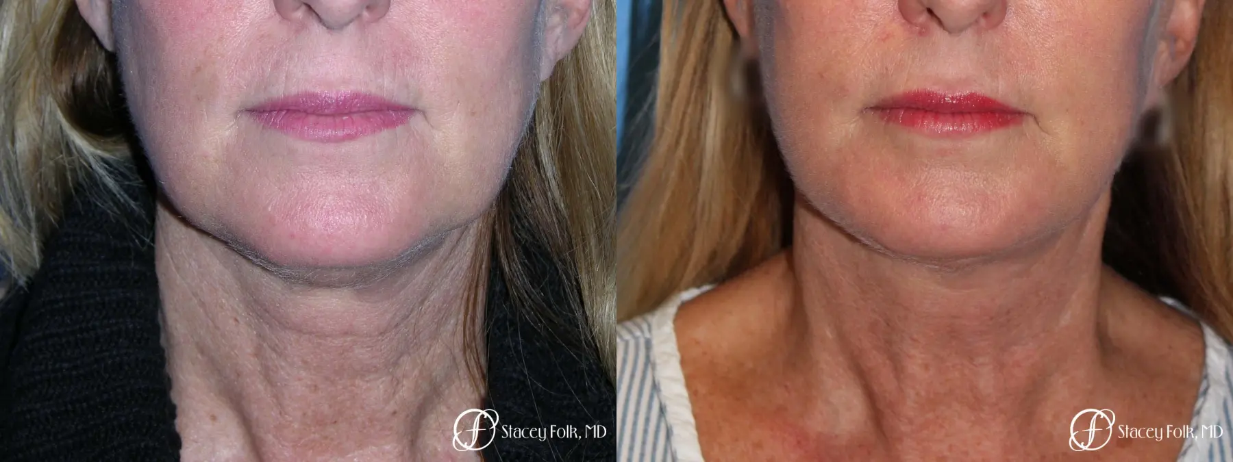 Denver Facial Rejuvenation 7916 - Before and After