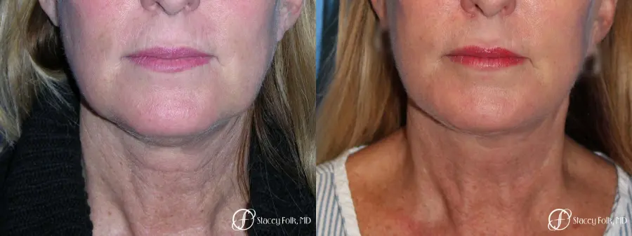 Denver Facial Rejuvenation 7916 - Before and After 1