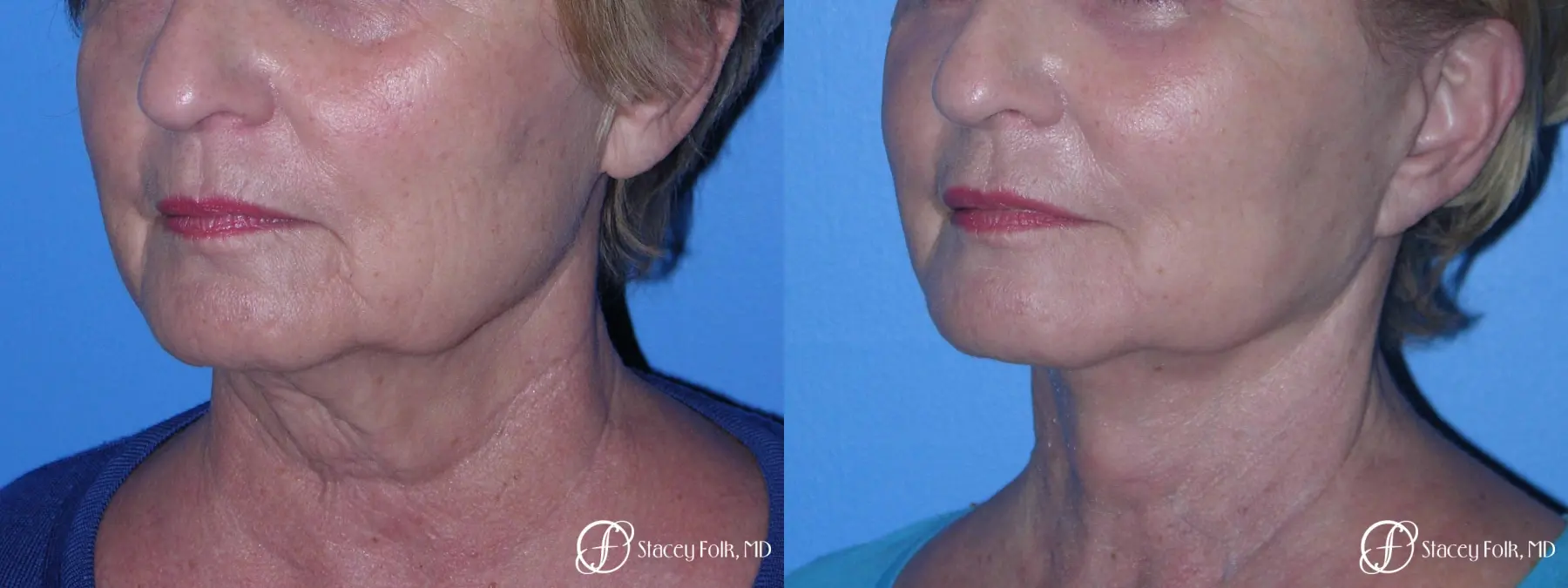 Denver Facial Rejuvenation Face Lift, Fat Injections, and Laser Resurfacing 7120 - Before and After 2