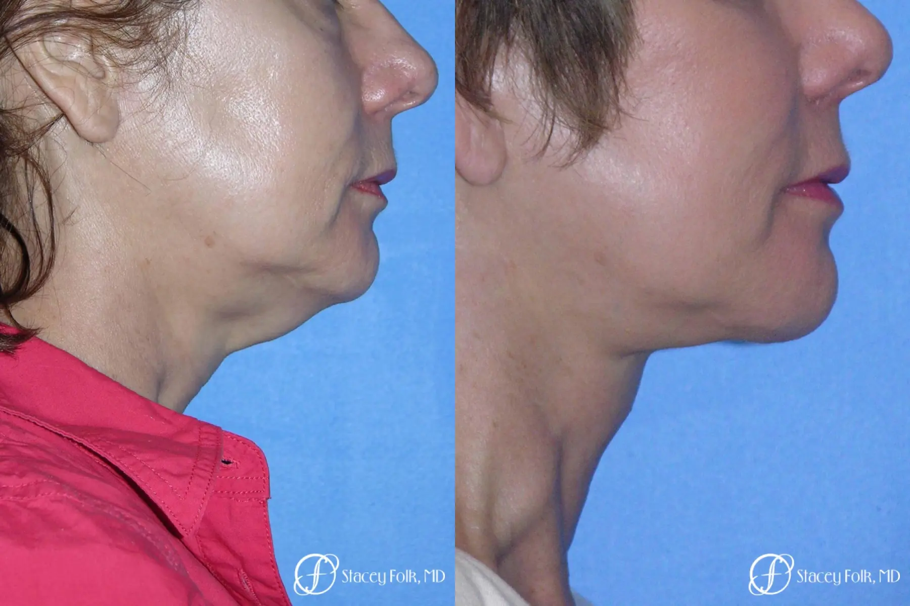 Denver Facial Rejuvenation Face Lift and Fat Injections 7117 - Before and After 1
