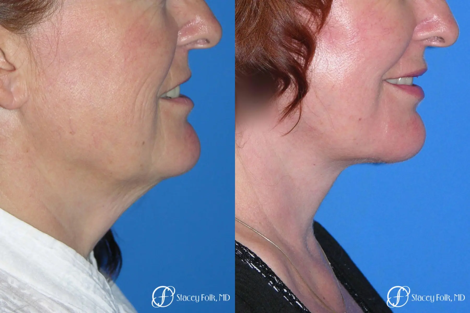 Denver Facial Rejuvenation Face lift, Fat Injections, Laser Resurfacing 7133 - Before and After