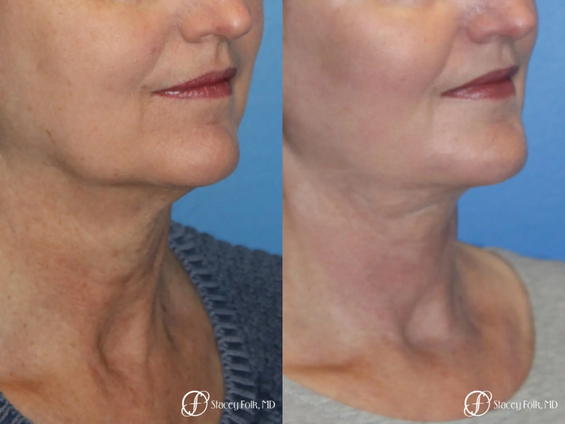 Denver Facial Rejuvenation Facelift, Blepharoplasty, Fat Transfer, Laser Resurfacing 10350 - Before and After 3