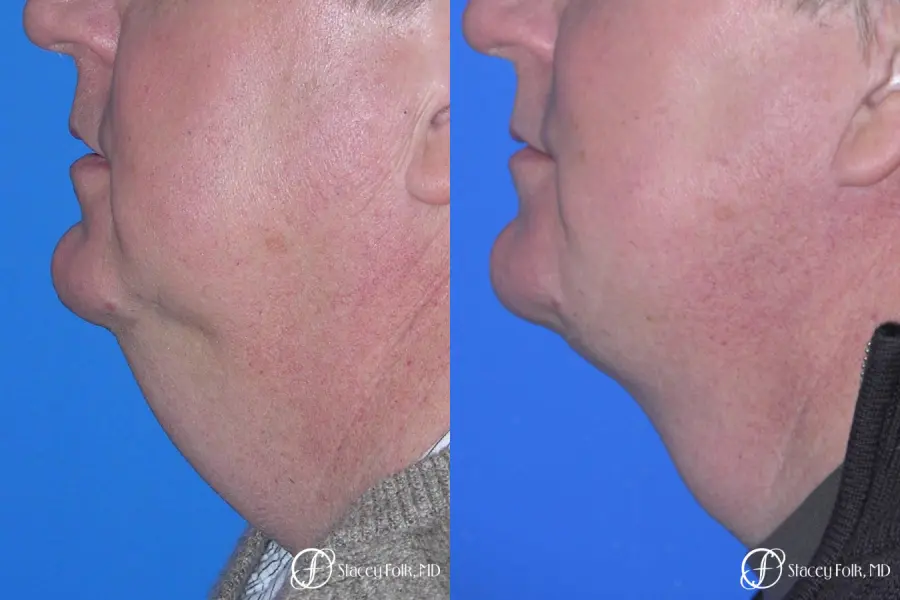 Denver Facial Rejuvenation Face lift, and Fat injections 7157 - Before and After 1