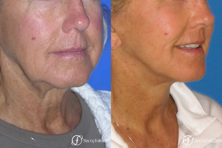 Denver Facial Rejuvenation Face Lift and Laser Resurfacing 7119 - Before and After 2
