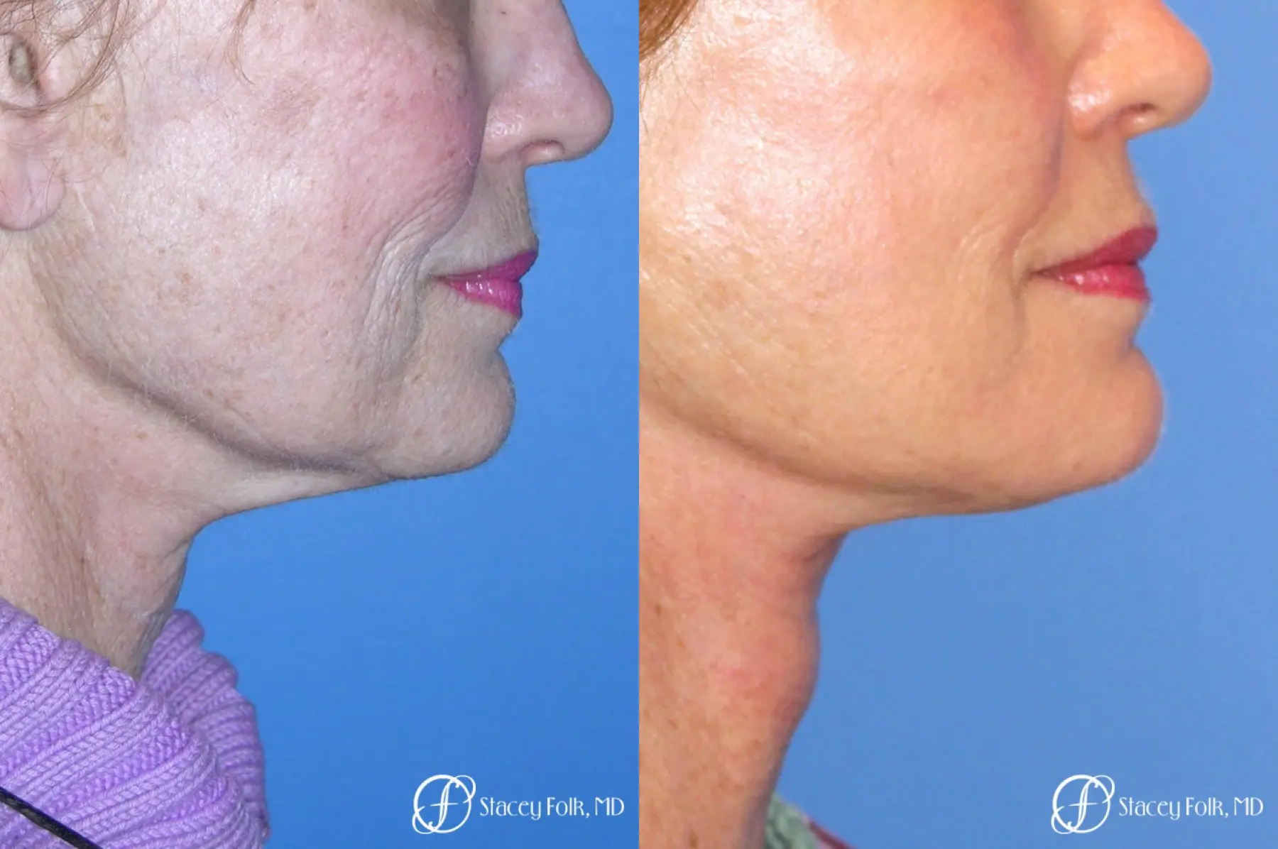 Denver Facial Rejuvenation Face Lift, Fat Injections, Laser Resurfacing 7116 - Before and After 1