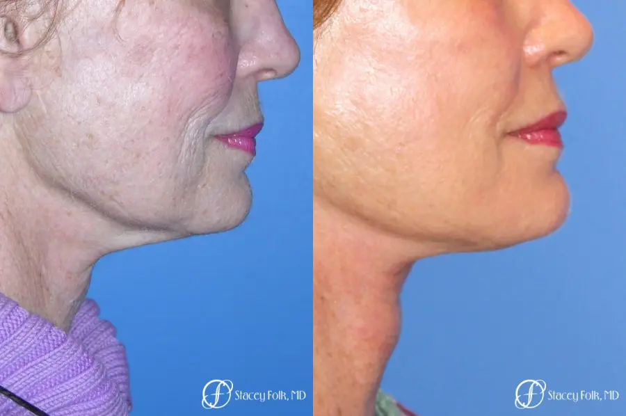 Denver Facial Rejuvenation Face Lift, Fat Injections, Laser Resurfacing 7116 - Before and After 1