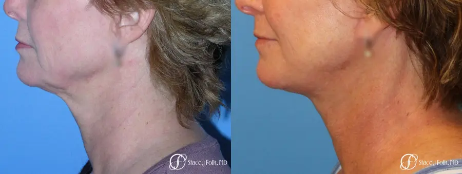Denver Facial Rejuvenation Face Lift 7121 - Before and After 1