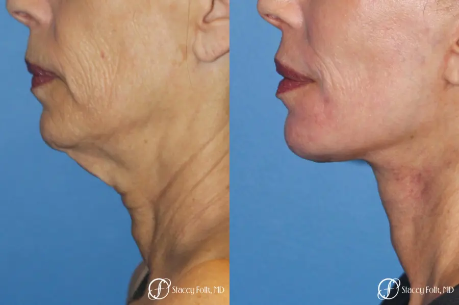 Facelift, Fat Transfer, Laser - Before and After