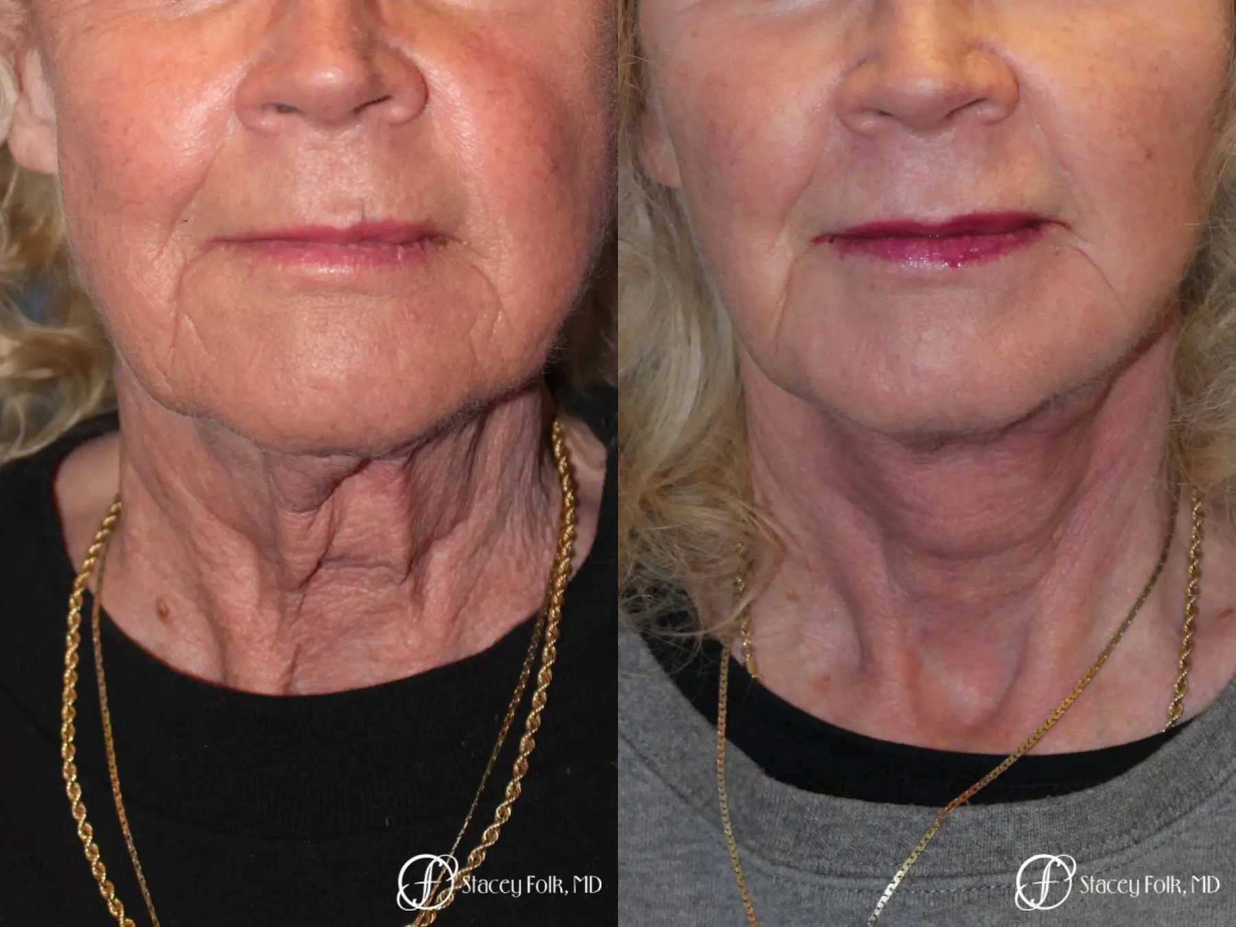 Denver Facial Rejuvenation Face lift, Fat Injections, and Laser Resurfacing 7131 - Before and After 3