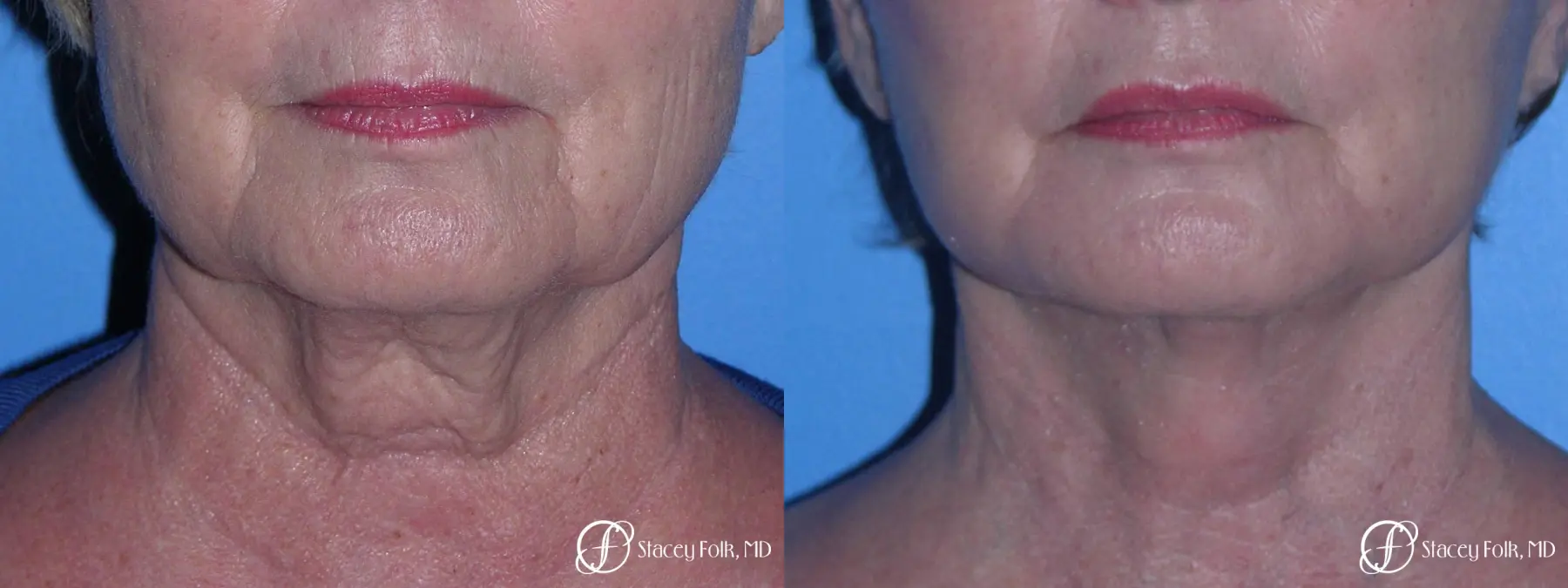Denver Facial Rejuvenation Face Lift, Fat Injections, and Laser Resurfacing 7120 - Before and After 3