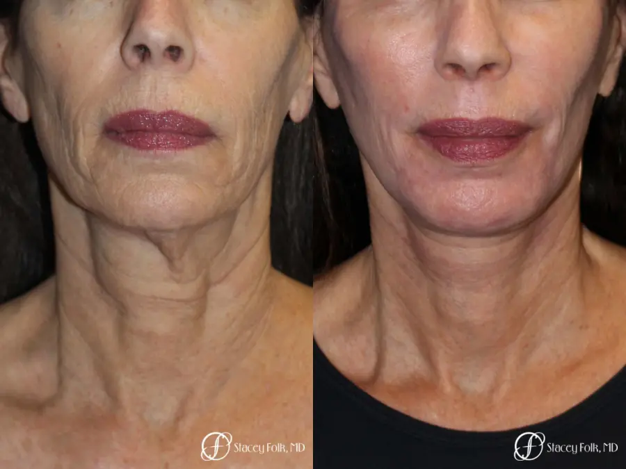 Facelift, Fat Transfer, Laser - Before and After 2