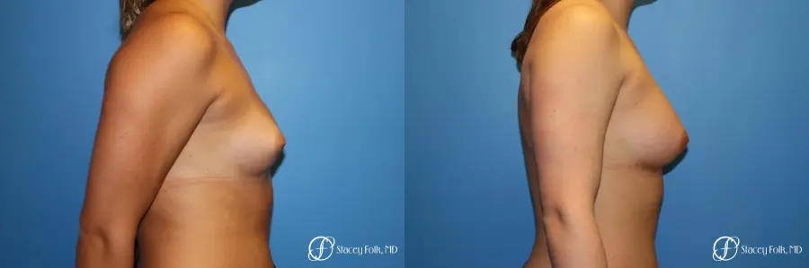Fat Transfer Breast Augmentation - Before and After 3