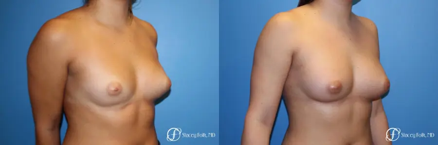 Fat Transfer Breast Augmentation - Before and After 2
