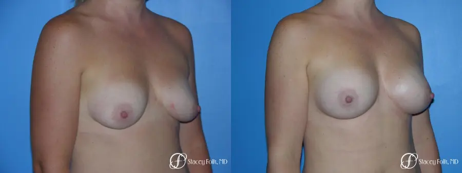 Denver Breast Augmentation with Fat Transfer to the Breast 6917 - Before and After 2
