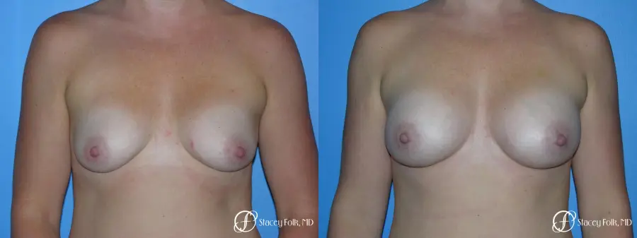Denver Breast Augmentation with Fat Transfer to the Breast 6917 - Before and After
