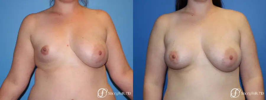 Fat Transfer To Right Breast - Before and After