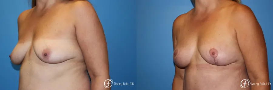 Denver Fat Transfer Breast Lift Mastopexy with Fat Transfer to the Breast 6920 - Before and After 2