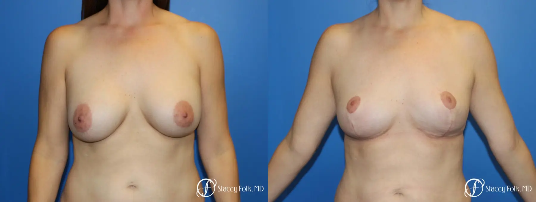 Fat Transfer Breast Lift (Mastopexy) - Before and After