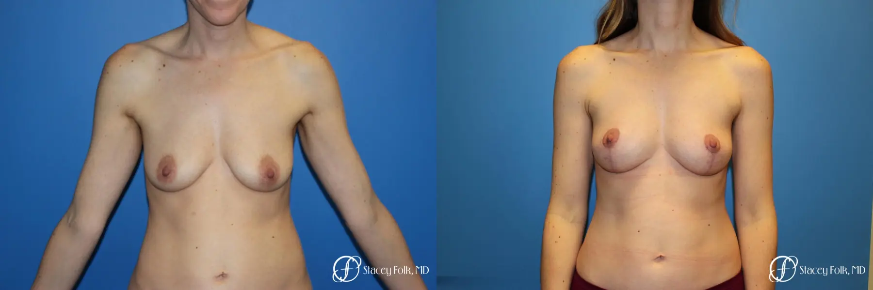 Fat Transfer Breast Lift: Patient 1 - Before and After  