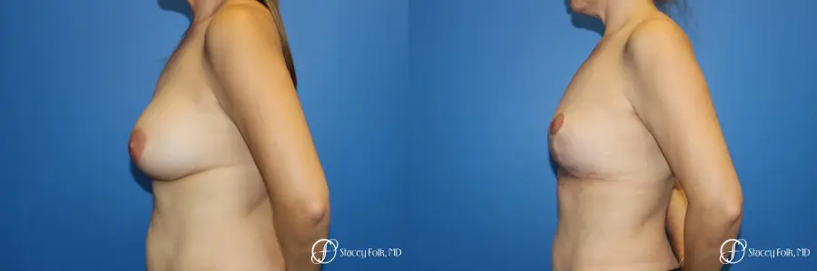 Fat Transfer Breast Lift (Mastopexy) - Before and After 3