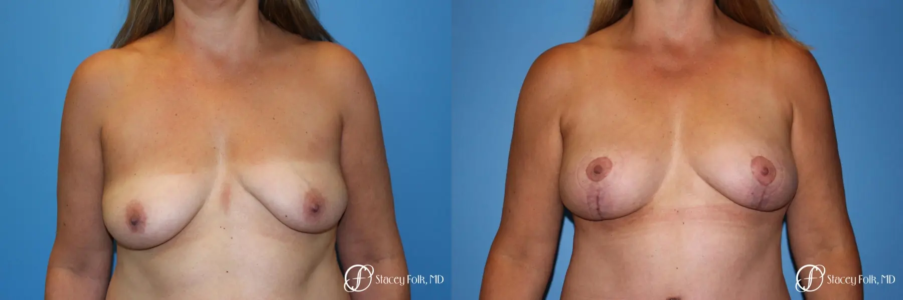 Denver Fat Transfer Breast Lift Mastopexy with Fat Transfer to the Breast 6920 - Before and After