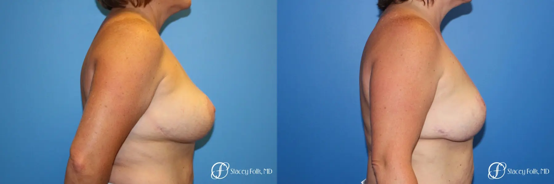 Breast Revision - Removal of Implant, Fat Transfer, Breast Lift (Mastopexy) - Before and After 3