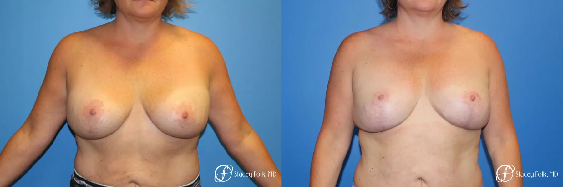 Breast Revision - Removal of Implant, Fat Transfer, Breast Lift (Mastopexy) - Before and After